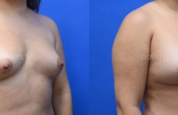 Liposuction of the abdomen and arms with fat transfer to the breasts | Sayah Institute
