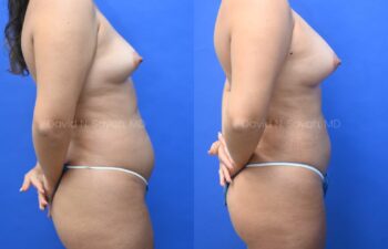 Liposuction of the abdomen and arms with fat transfer to the breasts | Sayah Institute