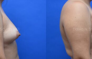 Liposuction of the abdomen and arms with fat transfer to the breasts | Sayah Institute