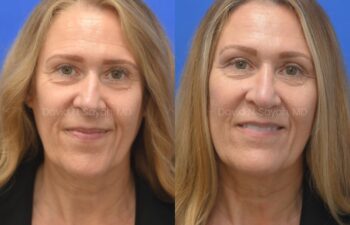 Side-by-side photos of a middle-aged woman showing her face before (left) and after (right) a cosmetic procedure, against a blue background.