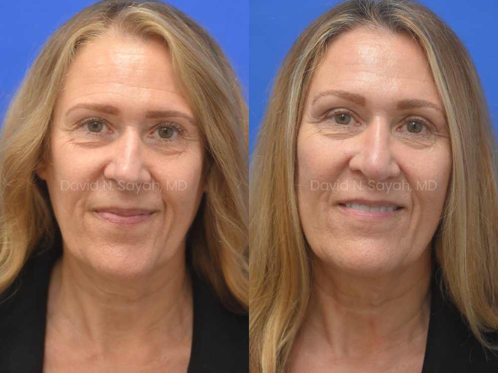 Side-by-side photos of a middle-aged woman showing her face before (left) and after (right) a cosmetic procedure, against a blue background.