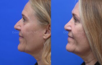 Side-by-side profile photos of a woman before and after a cosmetic procedure, showing changes in her chin and jawline against a blue background.