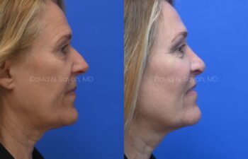 Side-by-side profile photos of a woman before and after a cosmetic procedure, showing a more defined jawline and chin in the after image.