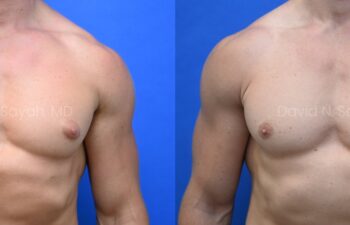 Side-by-side side-view comparison of a male chest before and after gynecomastia surgery, with the left image showing excess breast tissue and the right image showing a flatter, more contoured chest profile.