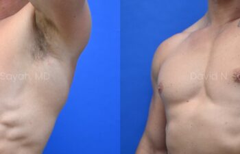 Side-by-side side-view comparison of a male chest before and after gynecomastia surgery, with the left image showing excess breast tissue and the right image showing a flatter, more contoured chest profile.