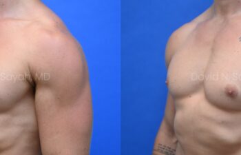 Side-by-side side-view comparison of a male chest before and after gynecomastia surgery, with the left image showing excess breast tissue and the right image showing a flatter, more contoured chest profile.