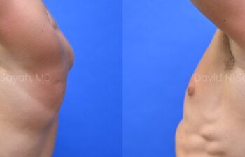 Side-by-side side-view comparison of a male chest before and after gynecomastia surgery, with the left image showing excess breast tissue and the right image showing a flatter, more contoured chest profile.