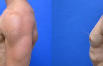 Side-by-side side-view comparison of a male chest before and after gynecomastia surgery, with the left image showing excess breast tissue and the right image showing a flatter, more contoured chest profile.