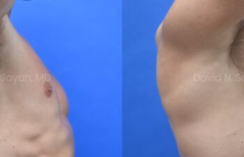 Side-by-side side-view comparison of a male chest before and after gynecomastia surgery, with the left image showing excess breast tissue and the right image showing a flatter, more contoured chest profile.