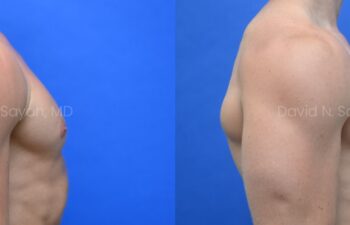 Side-by-side side-view comparison of a male chest before and after gynecomastia surgery, with the left image showing excess breast tissue and the right image showing a flatter, more contoured chest profile.
