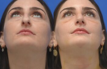 Side-by-side images of a woman looking up, showing the underside of her chin and jawline before and after a cosmetic procedure.