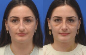 Side-by-side photos of a woman facing forward, showing her before (left) and after (right) a cosmetic procedure, with a neutral expression.