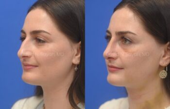 Side-by-side comparison of a woman’s face before (left) and after (right) a rhinoplasty, showing changes in her nose shape and slight bruising post-surgery.