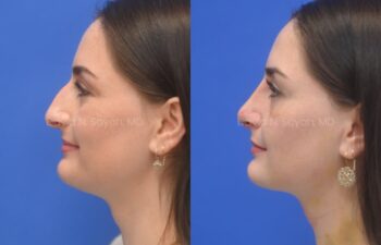 Side-by-side profile photos of a woman before (left) and after (right) rhinoplasty, showing changes to the shape of her nose against a blue background.