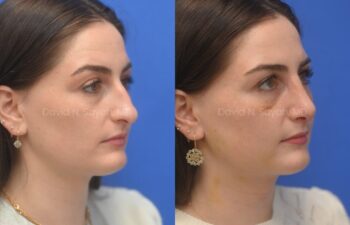 Side-by-side photos of a woman before and after a cosmetic procedure, showing changes in her nose profile against a blue background.