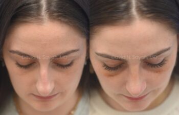 Side-by-side photos of a woman’s face before and after a cosmetic procedure, showing changes in skin tone and contour around the eyes and nose.