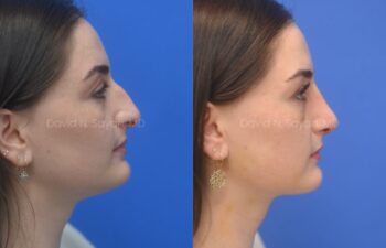 Side-by-side profile photos of a woman against a blue background, showing her nose before and after rhinoplasty surgery.
