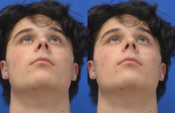 Side-by-side profile photos of a young man against a blue background, showing the nose before and after rhinoplasty and septoplasty, base view.