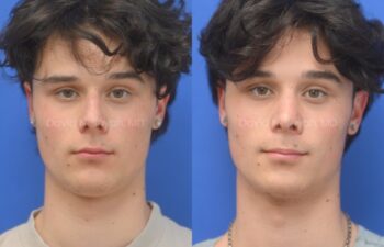 Side-by-side profile photos of a young man against a blue background, showing the nose before and after rhinoplasty and septoplasty, front view.