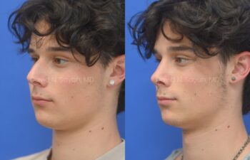 Side-by-side profile photos of a young man against a blue background, showing the nose before and after rhinoplasty and septoplasty, left oblique view.