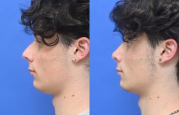 Side-by-side profile photos of a young man against a blue background, showing the nose before and after rhinoplasty and septoplasty, left view.