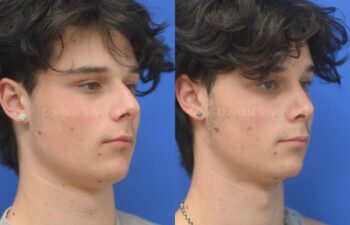 Side-by-side profile photos of a young man against a blue background, showing the nose before and after rhinoplasty and septoplasty, right oblique view.