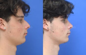 Side-by-side profile photos of a young man against a blue background, showing the nose before and after rhinoplasty and septoplasty, right view.