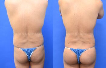 Male statuary body sculpting with deltoid, abdominal and bicep implants | Sayah Institute