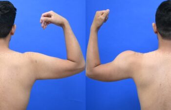 Male statuary body sculpting with deltoid, abdominal and bicep implants | Sayah Institute