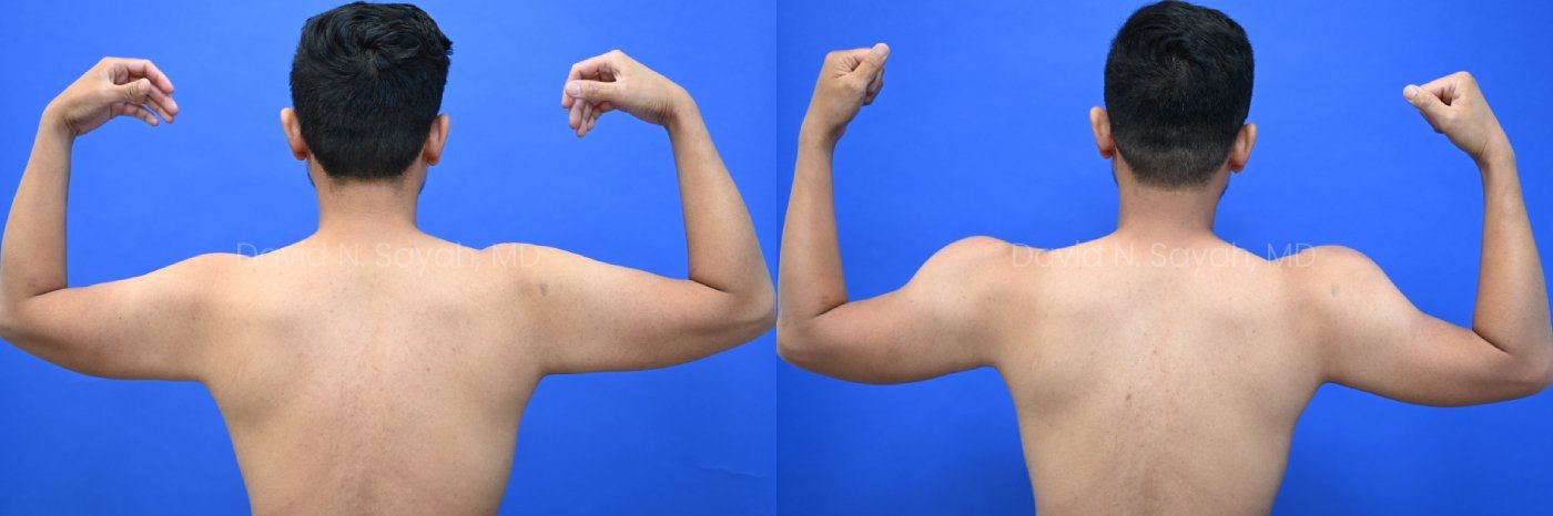 Male statuary body sculpting with deltoid, abdominal and bicep implants | Sayah Institute