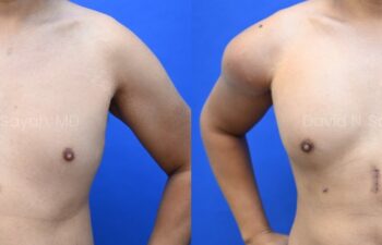 Male statuary body sculpting with deltoid, abdominal and bicep implants | Sayah Institute