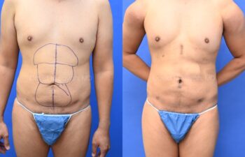 Male statuary body sculpting with deltoid, abdominal and bicep implants | Sayah Institute