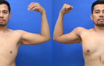 Male statuary body sculpting with deltoid, abdominal and bicep implants | Sayah Institute