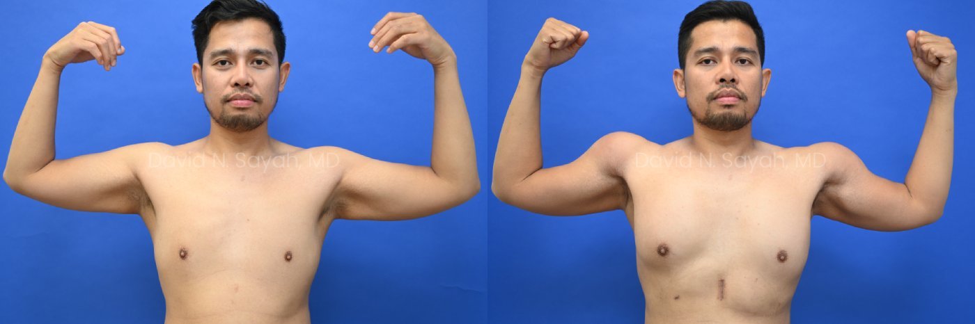 Male statuary body sculpting with deltoid, abdominal and bicep implants | Sayah Institute