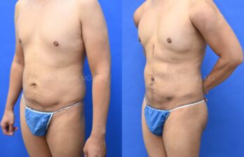 Male statuary body sculpting with deltoid, abdominal and bicep implants | Sayah Institute
