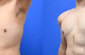 Male statuary body sculpting with deltoid, abdominal and bicep implants | Sayah Institute