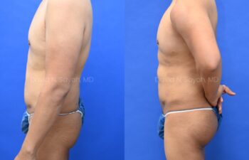 Male statuary body sculpting with deltoid, abdominal and bicep implants | Sayah Institute