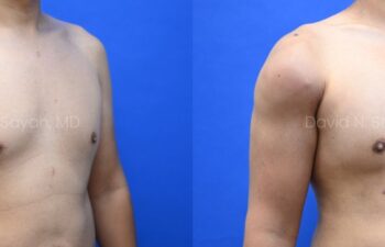Male statuary body sculpting with deltoid, abdominal and bicep implants | Sayah Institute
