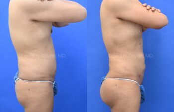 Male statuary body sculpting with deltoid, abdominal and bicep implants | Sayah Institute