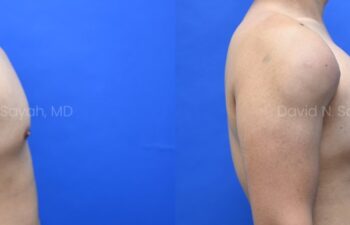 Male statuary body sculpting with deltoid, abdominal and bicep implants | Sayah Institute
