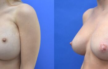 Breast reconstruction with silicone implants and nipple correction Before and After | Sayah Institute