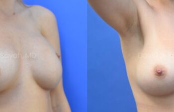 Breast reconstruction with silicone implants and nipple correction Before and After | Sayah Institute