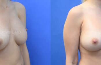 Breast reconstruction with silicone implants and nipple correction Before and After | Sayah Institute