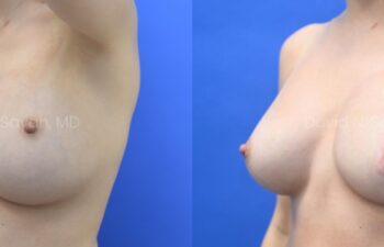 Breast reconstruction with silicone implants and nipple correction Before and After | Sayah Institute