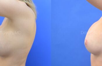 Breast reconstruction with silicone implants and nipple correction Before and After | Sayah Institute