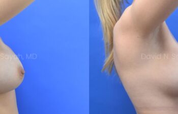 Breast reconstruction with silicone implants and nipple correction Before and After | Sayah Institute