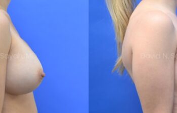 Breast reconstruction with silicone implants and nipple correction Before and After | Sayah Institute
