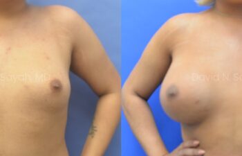 Before-and-after photo showing a person’s chest prior to and after breast augmentation surgery against a blue background.