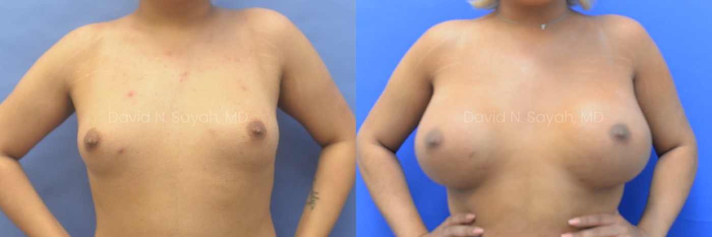 Before-and-after photo showing a person’s chest prior to and after breast augmentation surgery against a blue background.