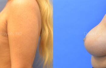 Side-by-side comparison of two women’s bare torsos against blue backgrounds, showing differences in breast size and shape.